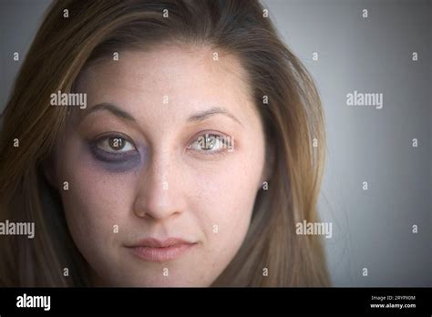 Portrait Of A Young Woman With A Black Eye Looking At Camera Stock