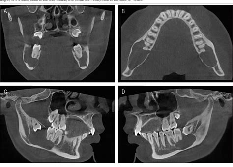 Figure 1 From Bilateral Mandibular Dentigerous Cysts In A Non Syndromic Patient Comprehensive