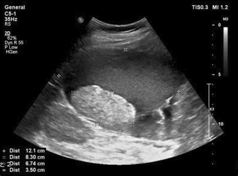 Ultrasound Image Of The Tumor Abdominal Ultrasonography Revealed A