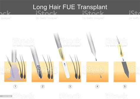 긴 머리 Fue 이식 모발 이식의 기술적 단계를 보여주는 의학에 대한 그림입니다 N 모낭에 대한 스톡 벡터 아트 및 기타 이미지
