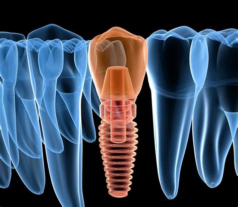 Implantologia Dental Qu Es Y En Qu Consiste Clinica Chela