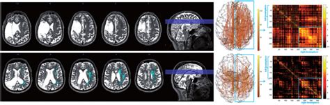 T 2 Weighted MRI Images From Two Patients Of The Study Sample