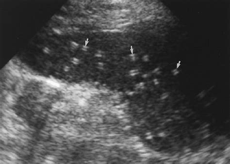 Splenic Calcifications Ultrasound Ultrasound Sonography Radiography