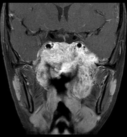 Juvenile Nasal Angiofibroma Radiology Case Radiopaedia Org