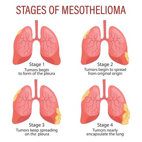 Premium Vector Stages Of Mesothelioma Lung Disease Healthcare Medical