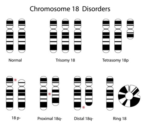 18 Chromosome Monosomy Disabilities