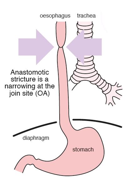 Esophagus Constriction