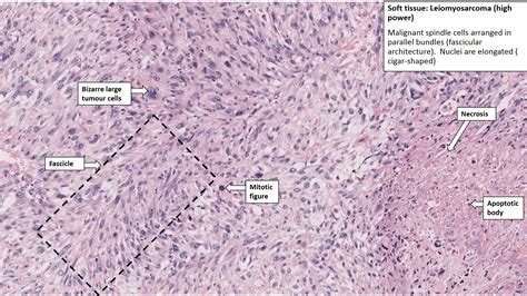 Thigh Leiomyosarcoma Nus Pathweb Nus Pathweb