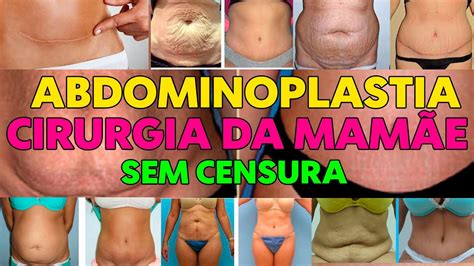 Abdominoplastia Antes E Depois Imagens Fortes Youtube