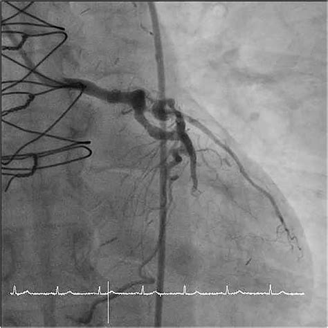 Tctap C A Challenging Case Report Kawasaki Disease With Graft