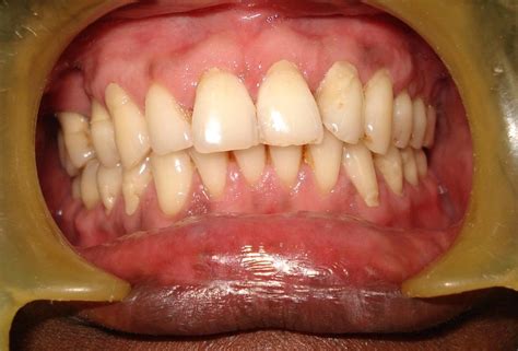 Pre Operative View Of Class Recession In And In A Male Patient