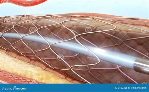 Angioplasty And Vascular Stenting Stock Illustration Illustration Of