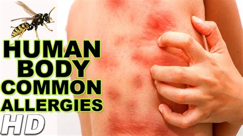 5 Common Allergies In Human Body Top Common Allergies Healthy Life