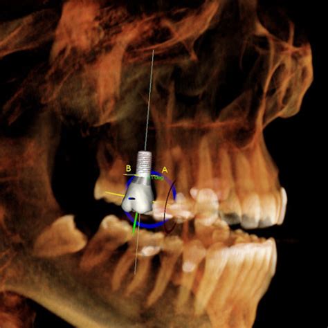 Risks Of A Dental Implant Anveli Dental Swiss Specialist In Implant