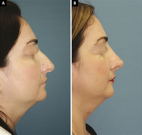 SciELO Brasil Percepção da redução nasal pela rinoplastia de