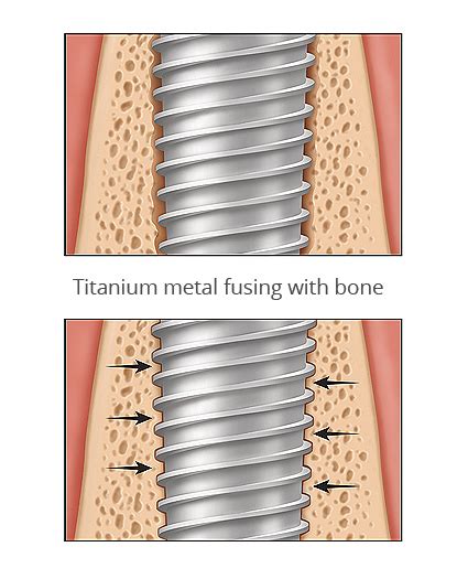 What Is Osseointegration Why Dental Implants