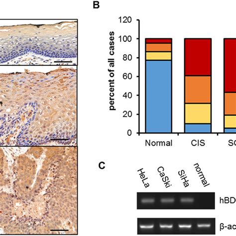 HBD3 Expression In Cervical Cancer Tissues And Cell Lines A