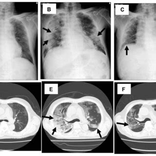 Chest X Ray A C And Computed Tomography D F Of The Case Patient