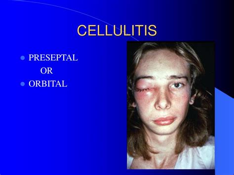 Ppt Periorbital Cellulitis Powerpoint Presentation Free Download