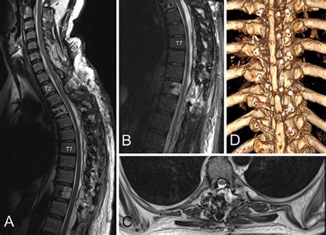 Sagittal T2 Weighted Mr Image After The Second Surgery A And With Fat