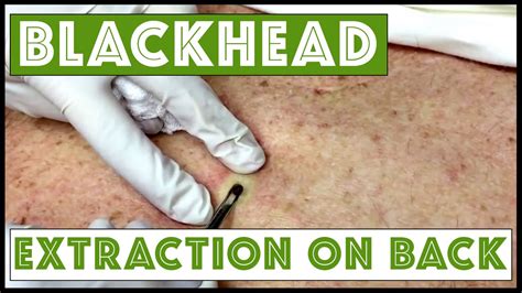 Blackhead Videos June 2017 - Sign up for free today ...