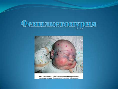 Фенилкетонурия