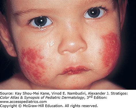 Cutaneous Viral Infections Ethiopathogenesis Presentation