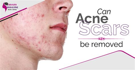 Can Acne Scars Be Removed Acne Scar Treatment In Delhi Ncr