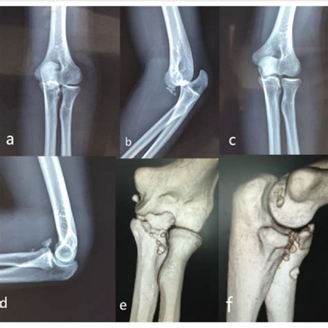 Illustration Depicting The Daa To The Coronoid Process Fracture Download Scientific Diagram