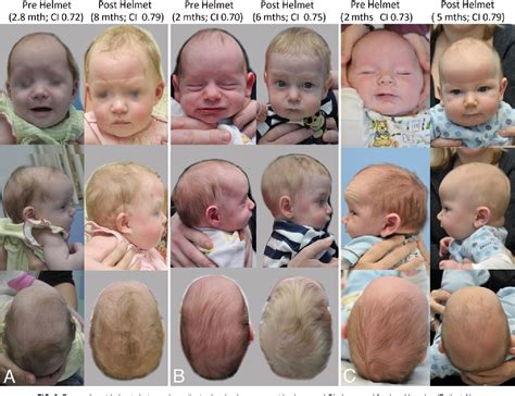 [PDF] Effect of molding helmets on intracranial pressure and head shape ...