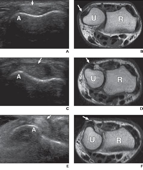 Figure 5—20 From Ultrasound Imaging Of Normal Displacement Of The