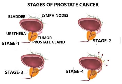 Prostate Cancer Types