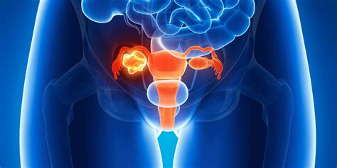 Ovarian Cancer Diagnosis Why Early Detection Is So Difficult