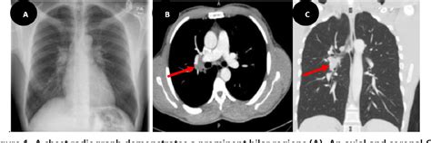 Figure 1 From Unmasking Tuberculosis Isolated Hilar Adenopathy In An Asymptomatic