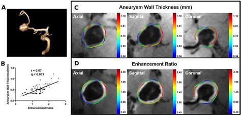 Quantitative Analysis Of Unruptured Intracranial Aneurysm Wall