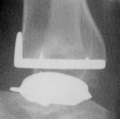 Heterotopic Ossification After Total Ankle Arthroplasty Bone And Joint