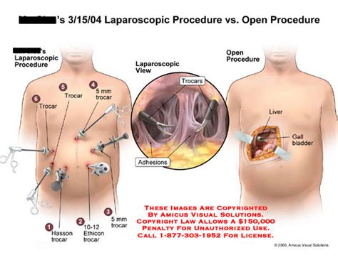 Amicus Illustration Of Amicussurgerylaparoscopicviewprocedureopentrocaradhesionsincision