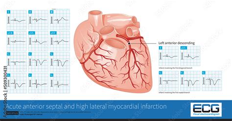 Acute Lateral Myocardial Infarction Hot Sex Picture