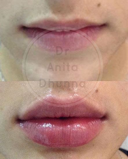 List 99 Pictures Vascular Occlusion Lip Filler Pictures Superb