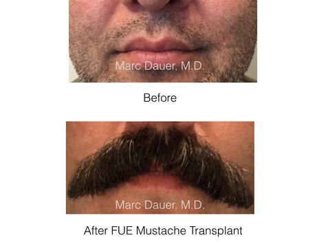 Facial Transplant Beard Hair Transplant Before And After Photos