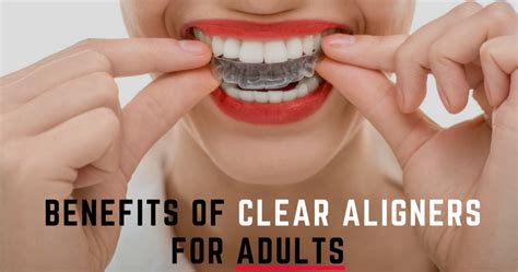 Benefits Of Clear Aligners For Adults In Ocnomowoc Wi