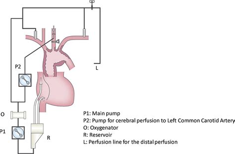 Impact Of Isolated Cerebral Perfusion Technique For Aortic Arch