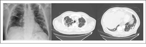 Figure From A V B Targeted Molecular Pet Ct Imaging Of The Lungs