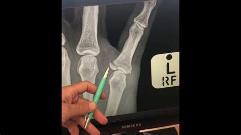 Avulsion Fracture Base Of Proximal Phalanx Youtube