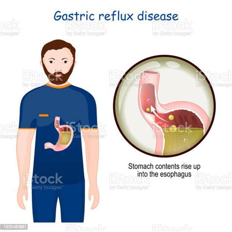 Gastroesophageal Reflux Disease Stock Illustration Download Image Now