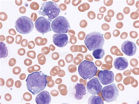 Acute Myelomonocytic Leukemia