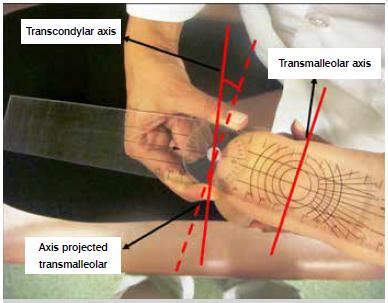 External Tibial Torsion