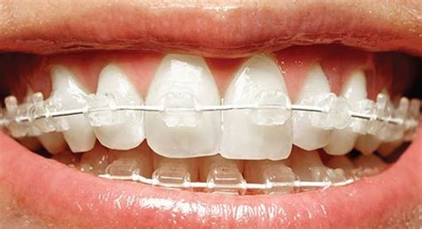 Straighten Teeth — Dentist Melbourne Invisalign Teeth Whitening