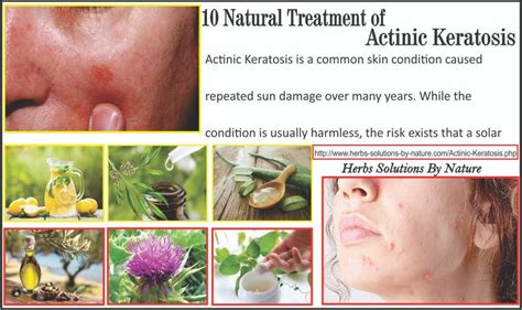 10 Actinic Keratosis Natural Cure And Home Remedies Joyson Medium