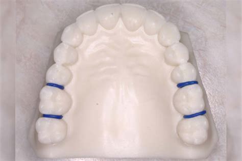 Separators or Spacers – Orthodontist Ottawa ON | Centrepointe Orthodontics